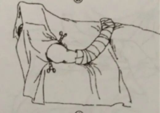 手术工具怎么消毒外科手术消毒、铺巾操作，做好这几个细节事半功倍！_https://www.jmylbn.com_新闻资讯_第17张