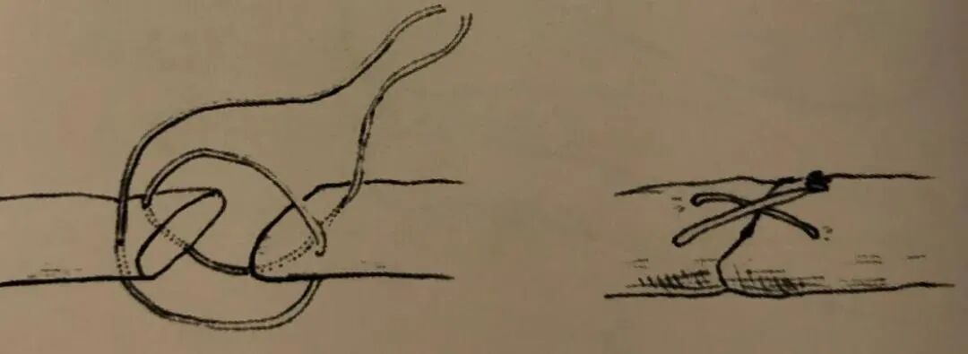 医疗缝线怎么做骨科精读 ｜ 如何做好手术缝合？这8种技术助你一臂之力！_https://www.jmylbn.com_新闻资讯_第25张