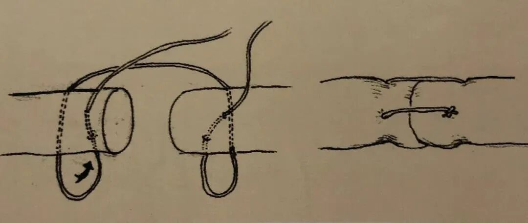 医疗缝线怎么做骨科精读 ｜ 如何做好手术缝合？这8种技术助你一臂之力！_https://www.jmylbn.com_新闻资讯_第24张