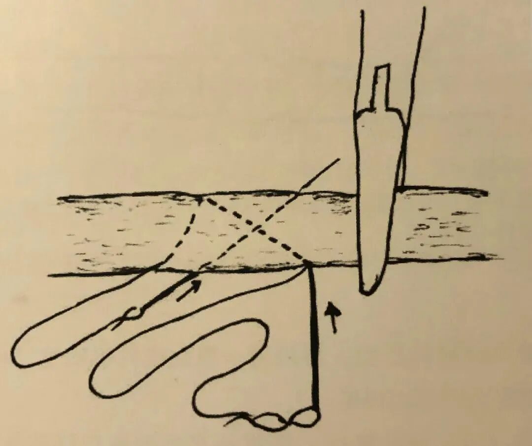 医疗缝线怎么做骨科精读 ｜ 如何做好手术缝合？这8种技术助你一臂之力！_https://www.jmylbn.com_新闻资讯_第20张