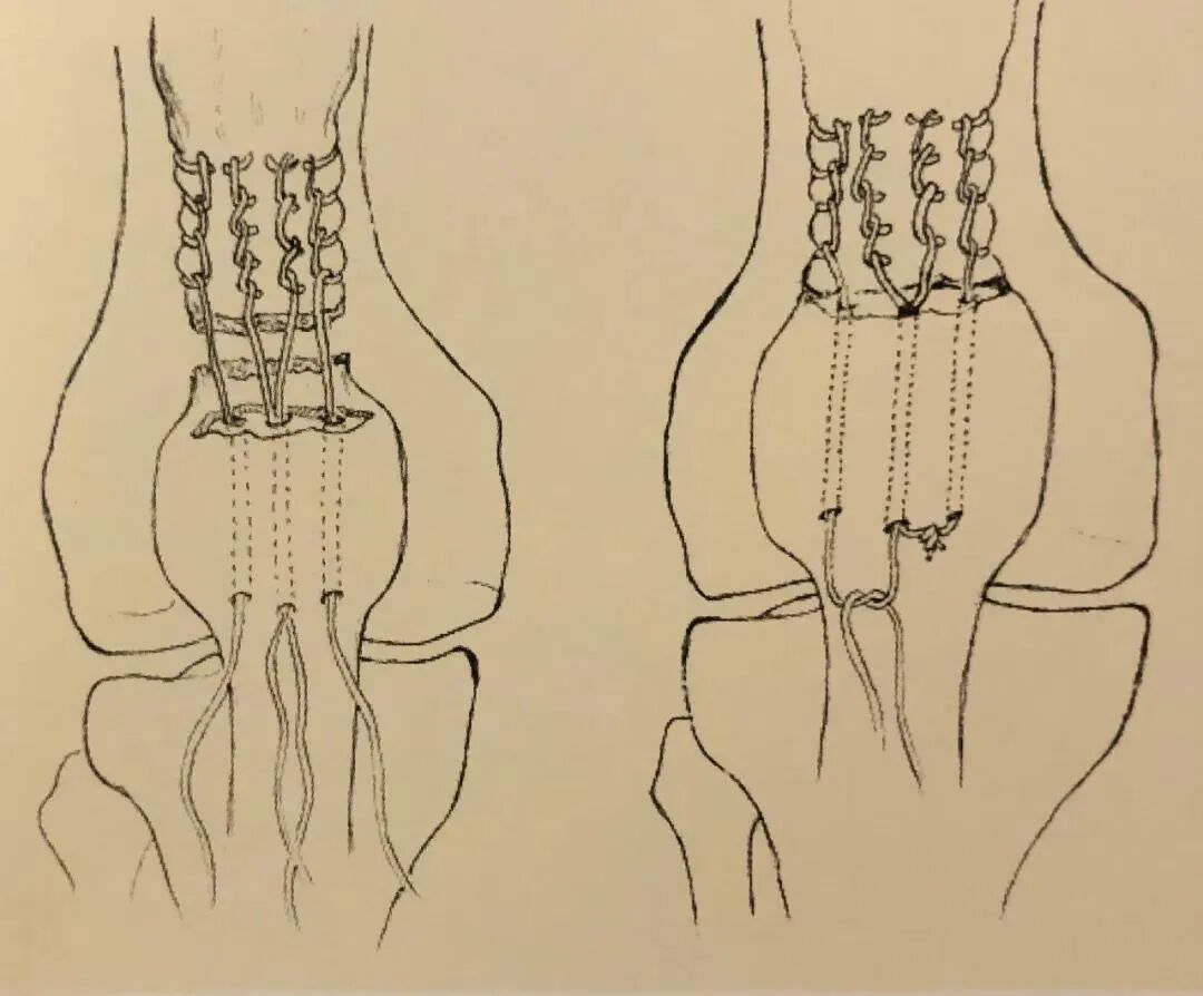 医疗缝线怎么做骨科精读 ｜ 如何做好手术缝合？这8种技术助你一臂之力！_https://www.jmylbn.com_新闻资讯_第30张
