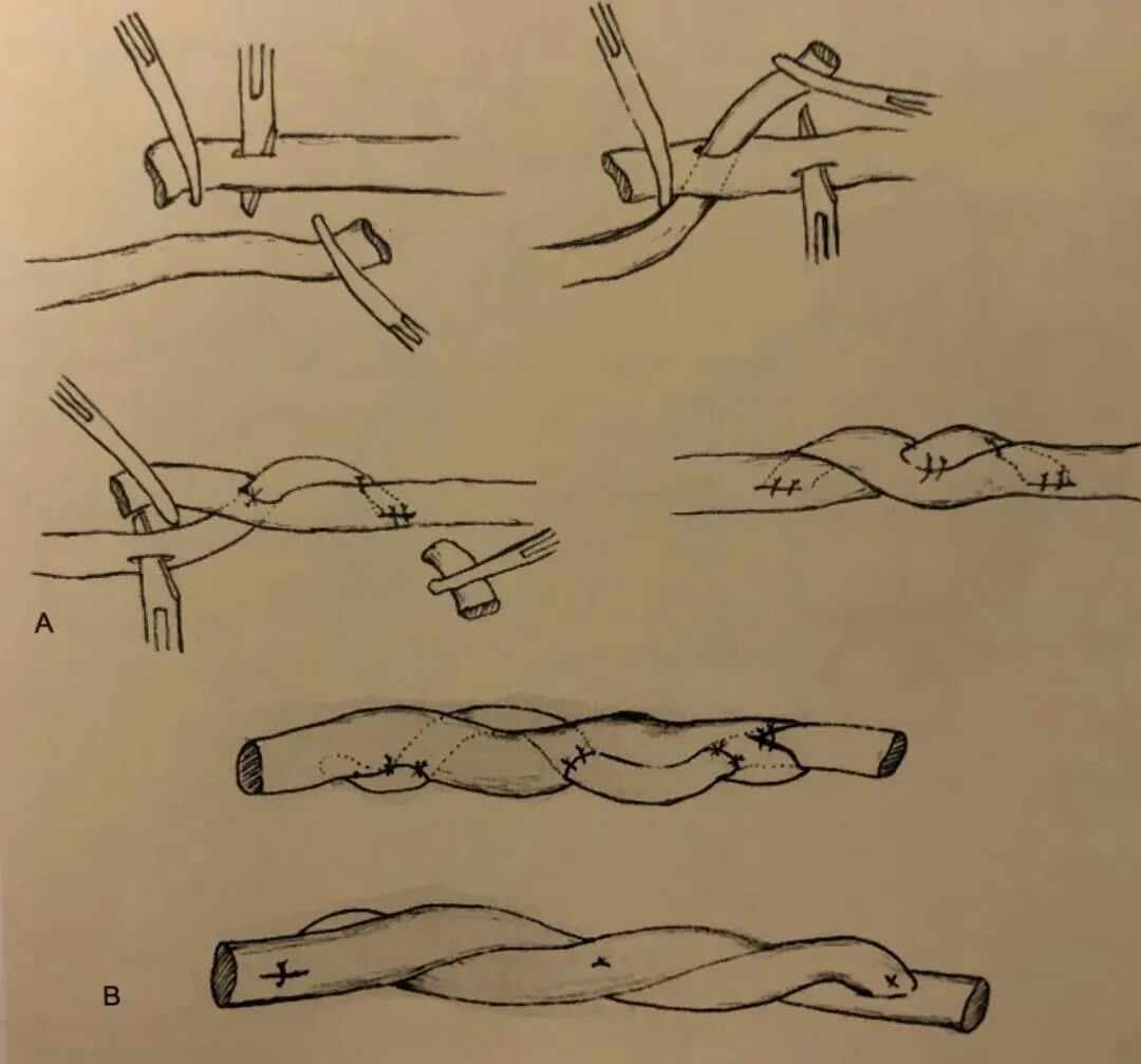 医疗缝线怎么做骨科精读 ｜ 如何做好手术缝合？这8种技术助你一臂之力！_https://www.jmylbn.com_新闻资讯_第26张