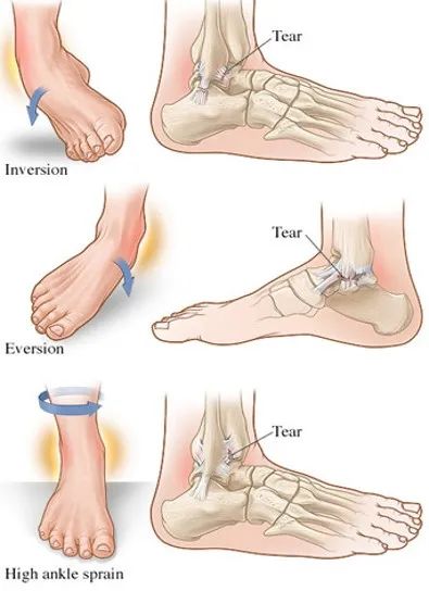 旋后损伤(内翻)旋前损伤(外翻)外旋损伤扭伤机制距骨在踝穴内有无倾斜