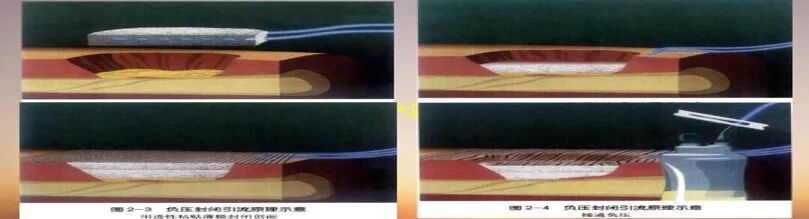 为什么负压引流骨科精读 ｜ 骨科常用的负压封闭引流术，一文读懂！_https://www.jmylbn.com_新闻资讯_第3张