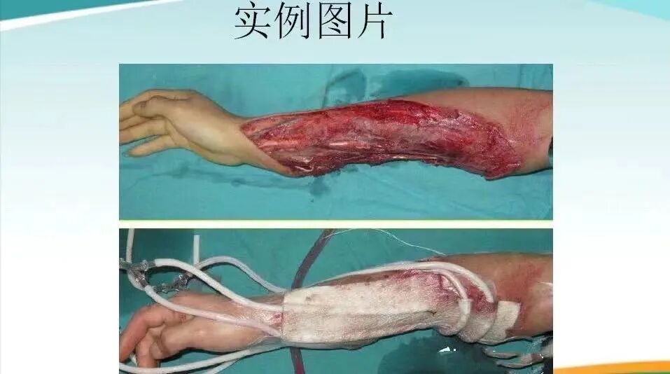 为什么负压引流骨科精读 ｜ 骨科常用的负压封闭引流术，一文读懂！_https://www.jmylbn.com_新闻资讯_第2张