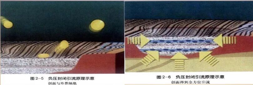 为什么负压引流骨科精读 ｜ 骨科常用的负压封闭引流术，一文读懂！_https://www.jmylbn.com_新闻资讯_第4张