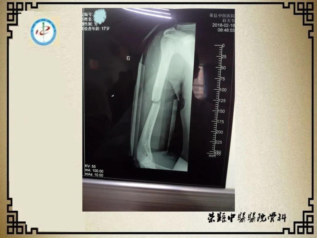 肱骨骨折闭合复位经皮锁定钢板前置内固定术！-德医学院-助力医学教育发展！