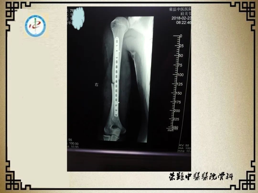 左肱骨中段陈旧性骨折内固定方法选择-专业文章