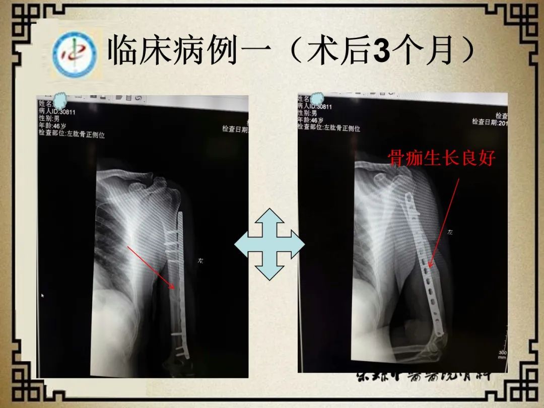 肱骨骨折闭合复位经皮锁定钢板前置内固定术！-德医学院-助力医学教育发展！