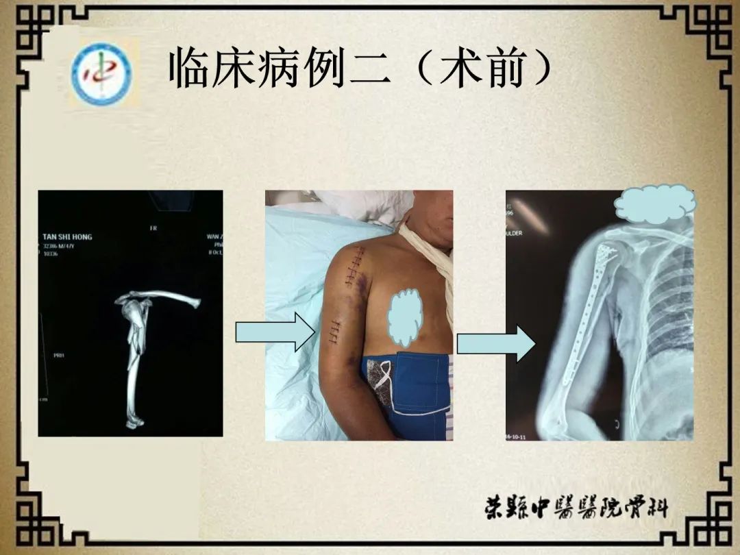 肱骨骨折闭合复位经皮锁定钢板前置内固定术！-德医学院-助力医学教育发展！