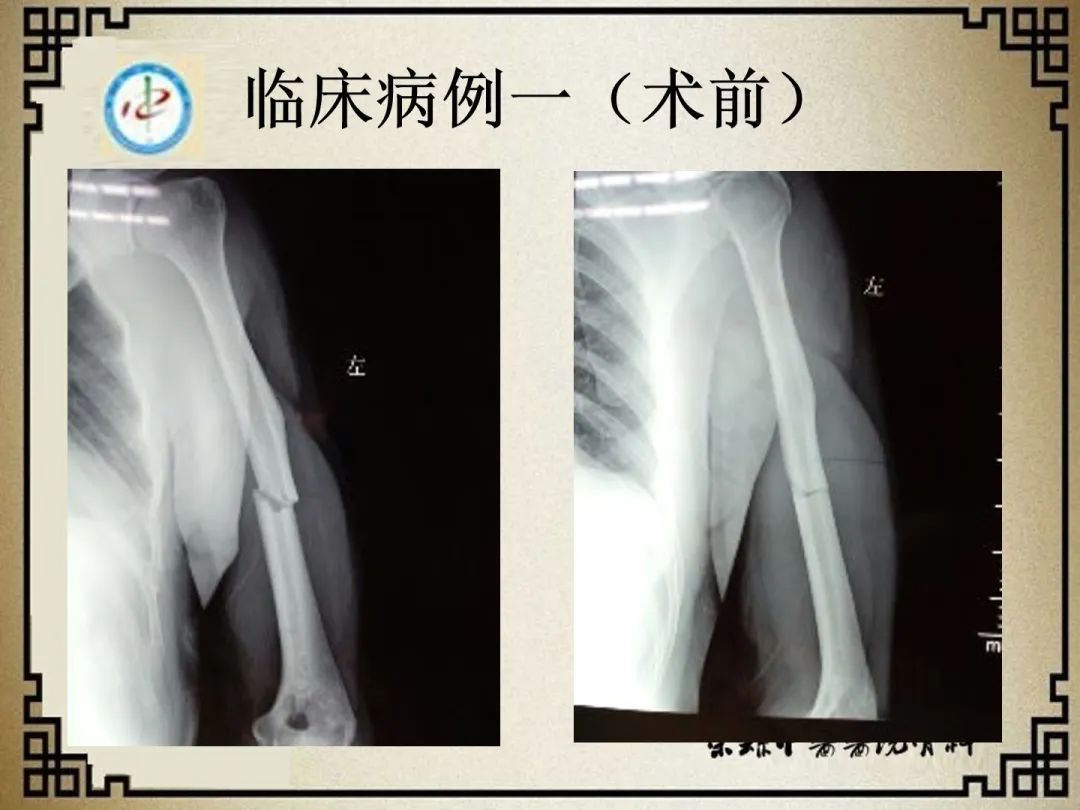 肱骨近端骨折：从分型、诊断、治疗到术后康复，全面讲解！ - 好医术早读文章 - 好医术-赋能医生守护生命