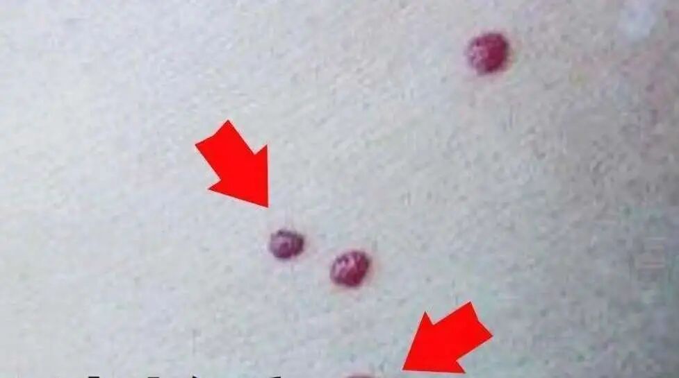 血痣是怎么回事？千万别掉以轻心，是肝胆病变前兆！