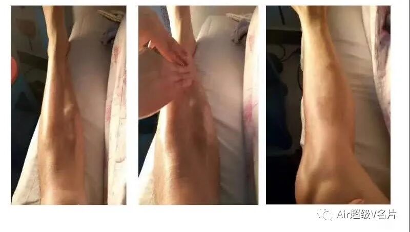 古法经络|调理静脉曲张的小方法，供大家参考！