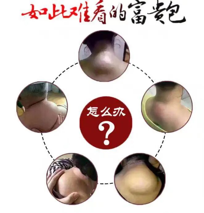 古法经络|富贵包：心脑血管“炸药包”！