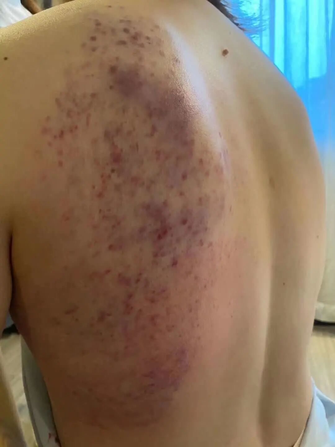 拍打出痧颜色形状不同，身体出现的问题就不同，有多少人重视过？