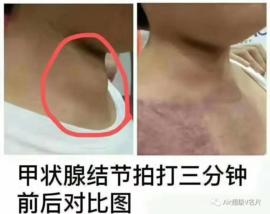 古法经络|甲状腺，困扰了无数人！关爱健康，从甲状腺谈起！