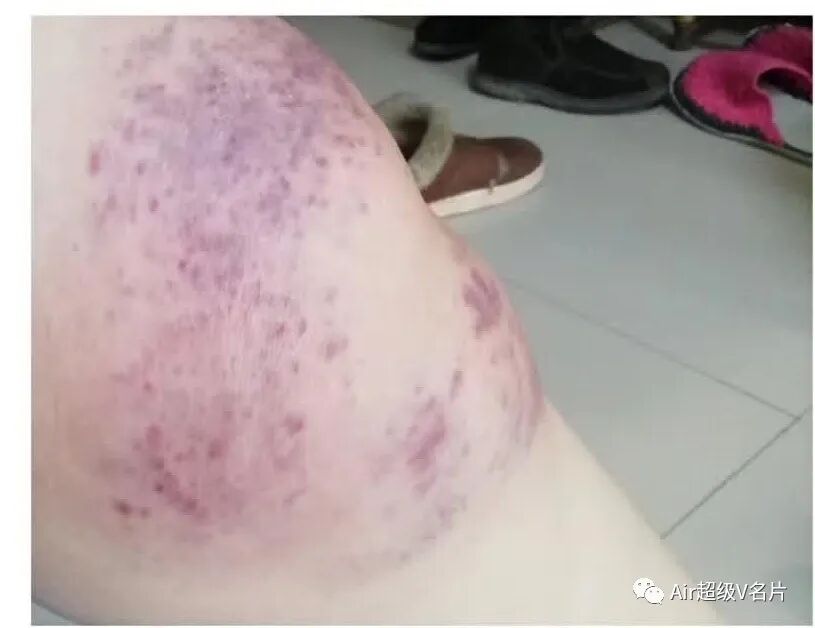 【语音】古法经络受益的学员分享调理膝关节！