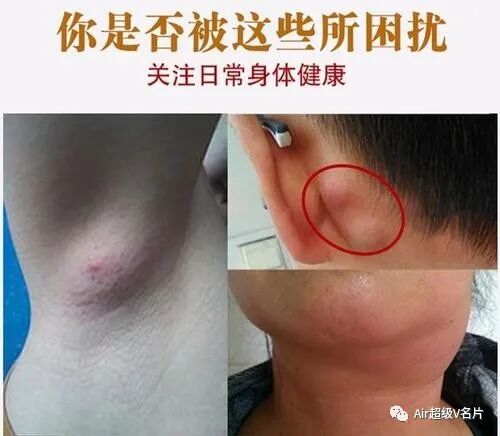 吓人！！这就是淋巴排毒的重要性‼️