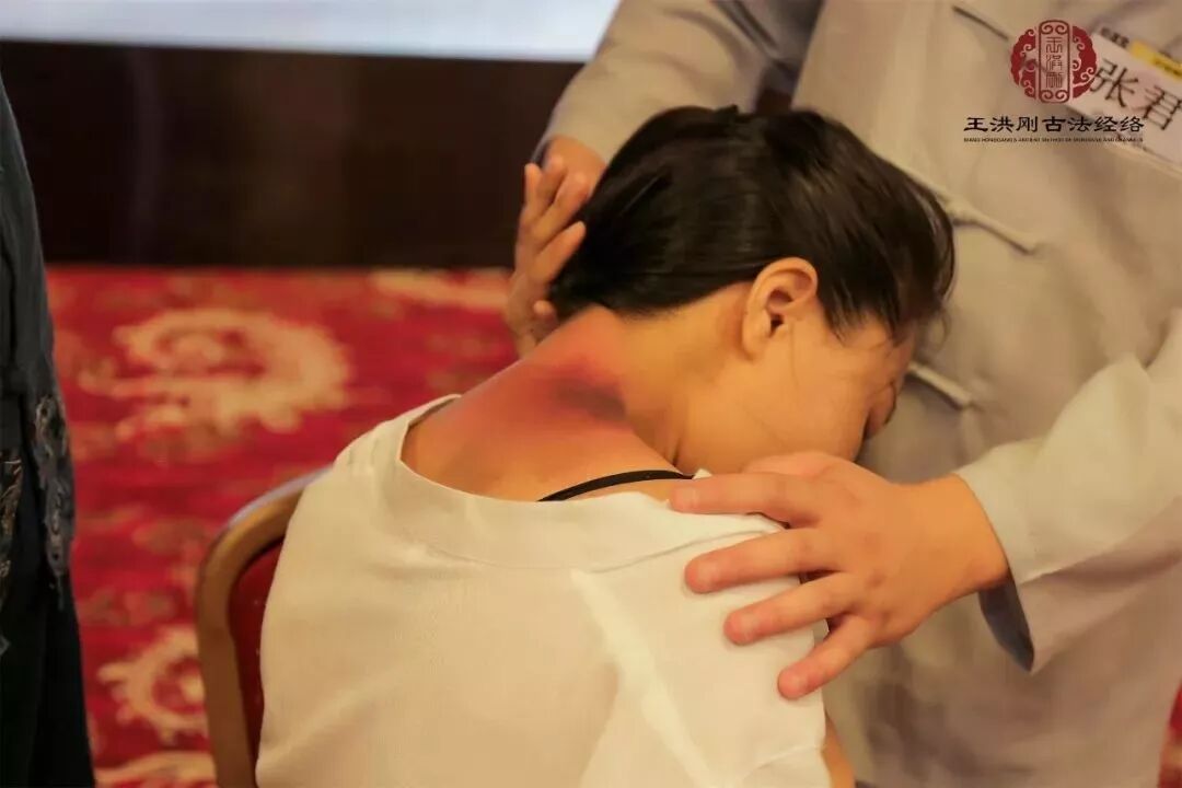 古法经络|罐有罐痕，痧有痧印，看痧印识病体！