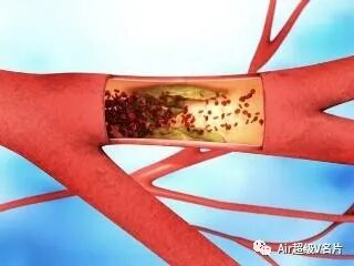 古法经络|生活中，要想预防脑血栓，保护血管，记住“三多三少”