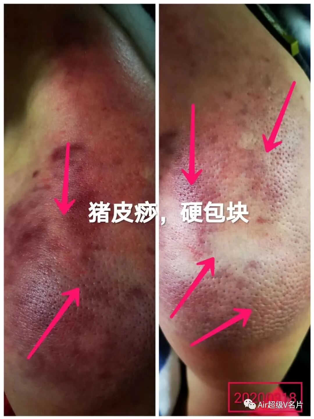 古法经络|如何拍打可以出痧，疏通经络？