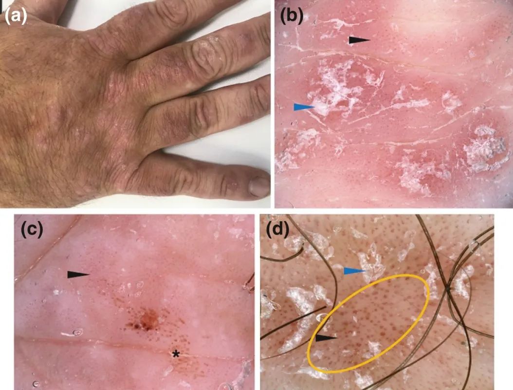 皮膚鏡輔助識別丘疹及其他累及手背的炎症性皮膚病_醫學界-助力醫生