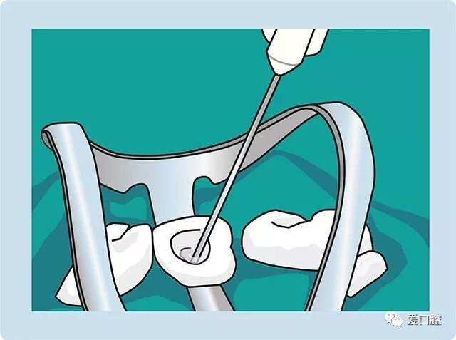 口腔冲洗液怎么喷牙科临床根管冲洗液次氯酸钠使用心得_https://www.jmylbn.com_新闻资讯_第2张