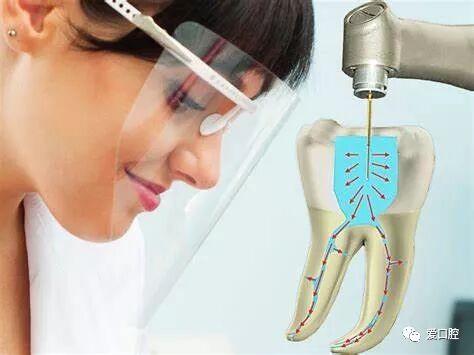 口腔冲洗液怎么喷牙科临床根管冲洗液次氯酸钠使用心得_https://www.jmylbn.com_新闻资讯_第4张