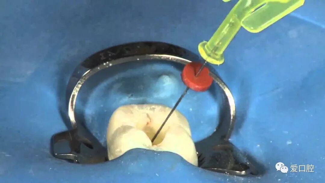 口腔冲洗液怎么喷牙科临床根管冲洗液次氯酸钠使用心得_https://www.jmylbn.com_新闻资讯_第5张