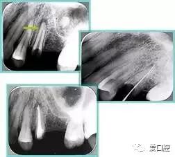 牙胶尖什么颜色最全整理 ｜ 根管治疗标准步骤和细节把握_https://www.jmylbn.com_新闻资讯_第36张
