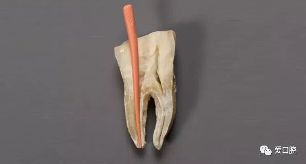 牙胶尖什么颜色根管治疗的标准步骤以及治疗细节的把握_https://www.jmylbn.com_新闻资讯_第3张