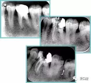 牙胶尖什么颜色根管治疗的标准步骤以及治疗细节的把握_https://www.jmylbn.com_新闻资讯_第28张