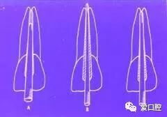 牙胶尖什么颜色根管治疗的标准步骤以及治疗细节的把握_https://www.jmylbn.com_新闻资讯_第10张