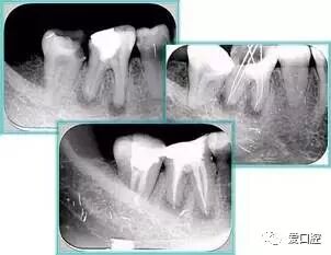 牙胶尖什么颜色根管治疗的标准步骤以及治疗细节的把握_https://www.jmylbn.com_新闻资讯_第24张