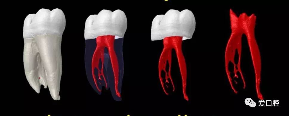 牙胶尖什么颜色根管治疗的标准步骤以及治疗细节的把握_https://www.jmylbn.com_新闻资讯_第2张