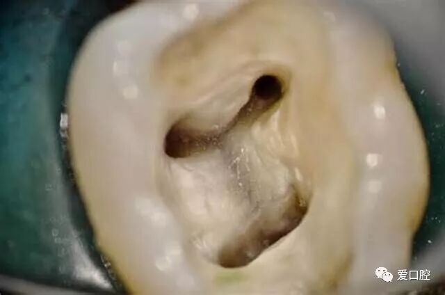 牙胶尖什么颜色根管治疗的标准步骤以及治疗细节的把握_https://www.jmylbn.com_新闻资讯_第36张