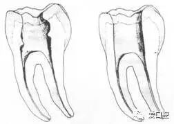 牙胶尖什么颜色根管治疗的标准步骤以及治疗细节的把握_https://www.jmylbn.com_新闻资讯_第7张
