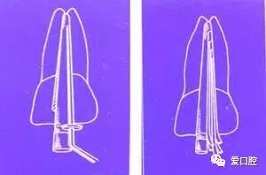 牙胶尖什么颜色根管治疗的标准步骤以及治疗细节的把握_https://www.jmylbn.com_新闻资讯_第17张