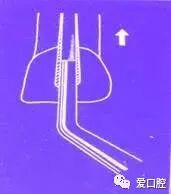 牙胶尖什么颜色根管治疗的标准步骤以及治疗细节的把握_https://www.jmylbn.com_新闻资讯_第18张