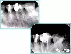 牙胶尖什么颜色根管治疗的标准步骤以及治疗细节的把握_https://www.jmylbn.com_新闻资讯_第25张