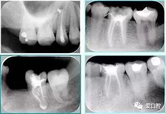 牙胶尖什么颜色根管治疗的标准步骤以及治疗细节的把握_https://www.jmylbn.com_新闻资讯_第22张