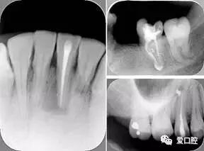 牙胶尖什么颜色根管治疗的标准步骤以及治疗细节的把握_https://www.jmylbn.com_新闻资讯_第19张