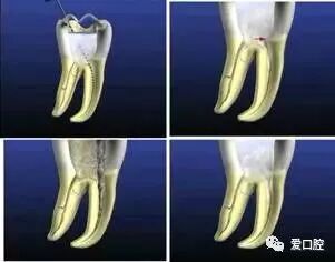 牙胶尖什么颜色根管治疗的标准步骤以及治疗细节的把握_https://www.jmylbn.com_新闻资讯_第6张