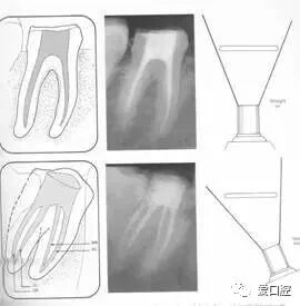 牙胶尖什么颜色根管治疗的标准步骤以及治疗细节的把握_https://www.jmylbn.com_新闻资讯_第20张