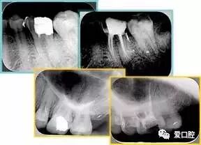 牙胶尖什么颜色根管治疗的标准步骤以及治疗细节的把握_https://www.jmylbn.com_新闻资讯_第26张