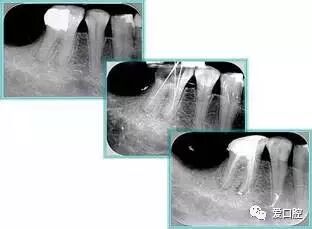 牙胶尖什么颜色最全整理 ｜ 根管治疗标准步骤和细节把握_https://www.jmylbn.com_新闻资讯_第39张