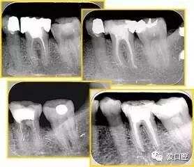 牙胶尖什么颜色根管治疗的标准步骤以及治疗细节的把握_https://www.jmylbn.com_新闻资讯_第27张