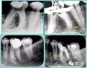 牙胶尖什么颜色最全整理 ｜ 根管治疗标准步骤和细节把握_https://www.jmylbn.com_新闻资讯_第37张