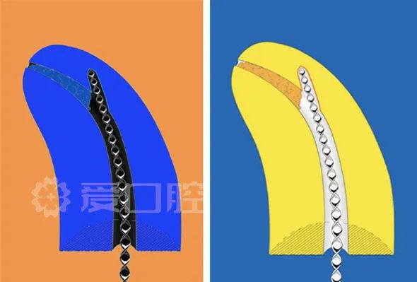 根尖偏移的三种类型，各有各的处理方法