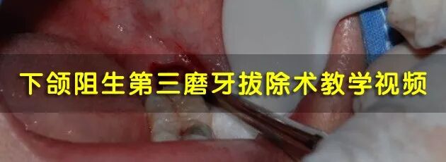 口腔冲洗液怎么喷牙科临床根管冲洗液次氯酸钠使用心得_https://www.jmylbn.com_新闻资讯_第10张